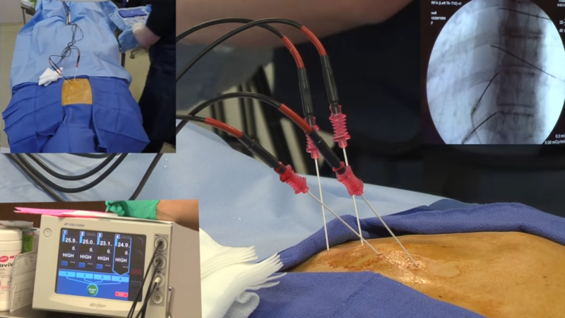 Radiofrequency Ablation