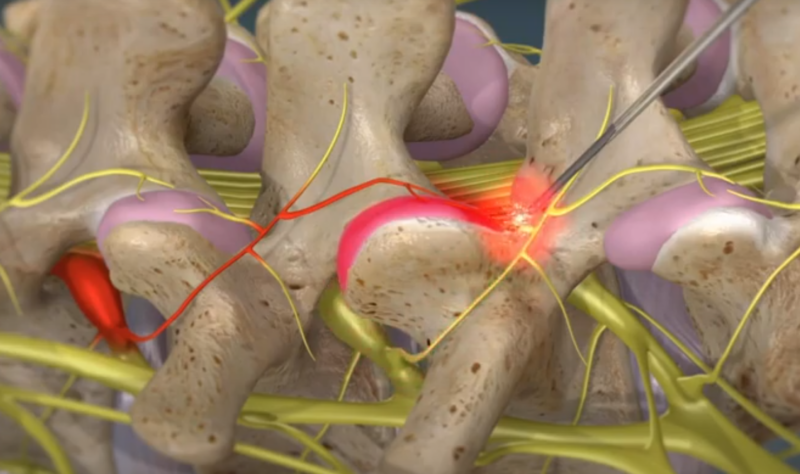 Rhizotomy